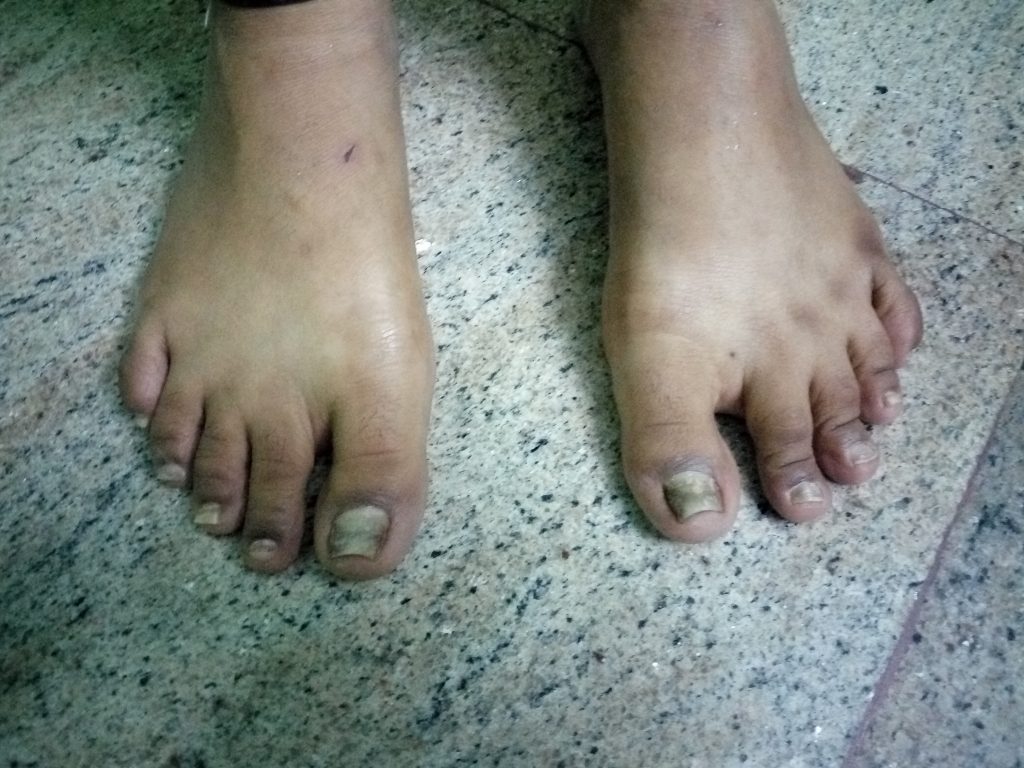 Nail Psoriasis