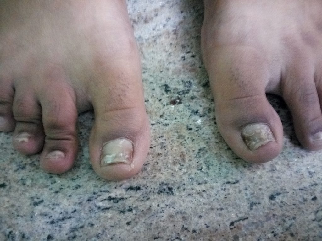 Nail Psoriasis