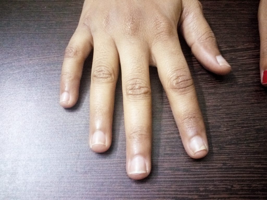 Nail Psoriasis