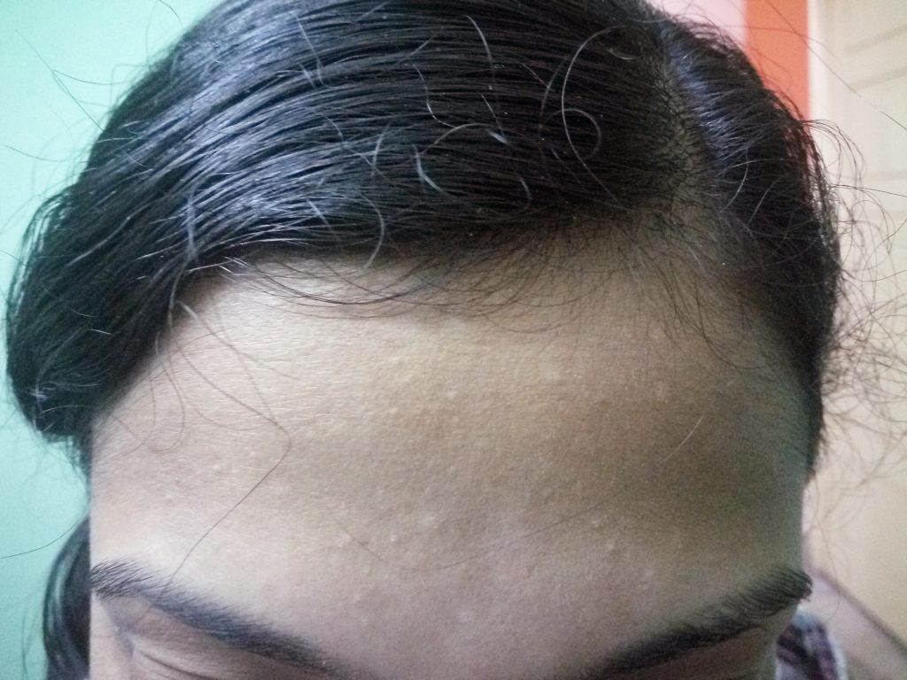Scalp Psoriasis