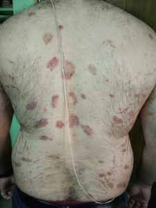 Ayurvedic Psoriasis treatment Case Study