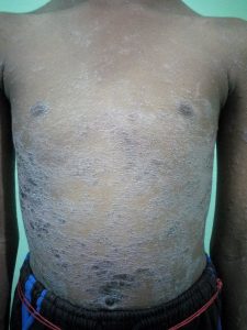 Psoriasis Treatment by Ayurveda