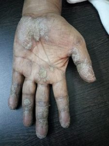 Complete Cure of Palmar Psoriasis
