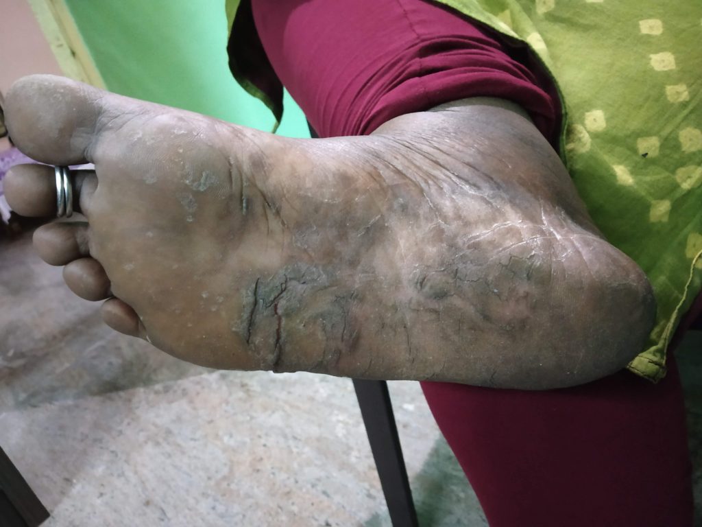 Plantar Psoriasis Treatment