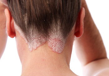 scalp-psoriasis