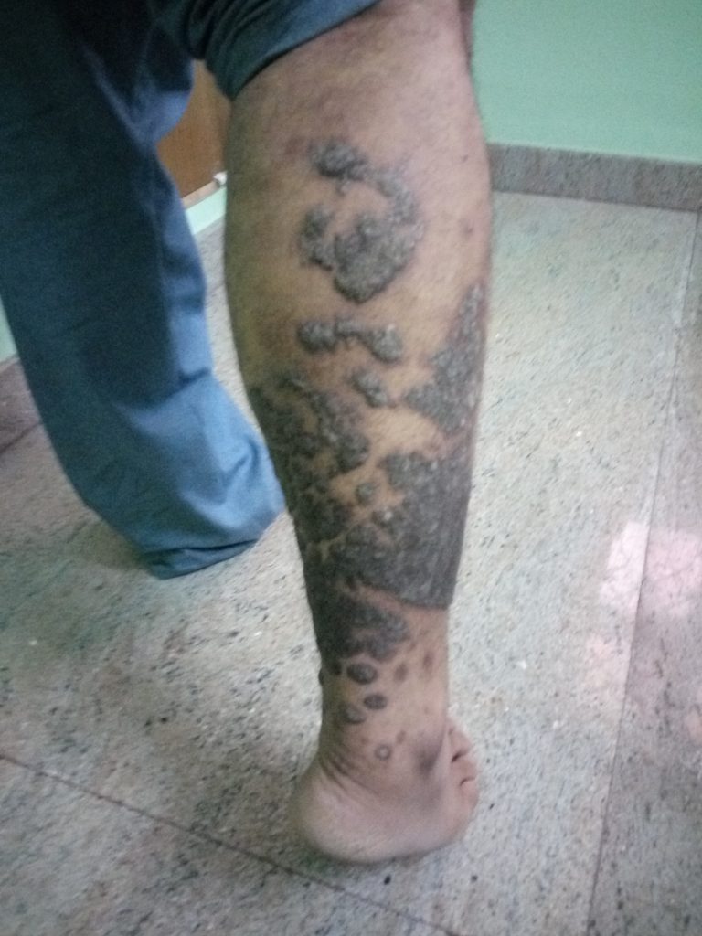 Plaque Psoriasis Images