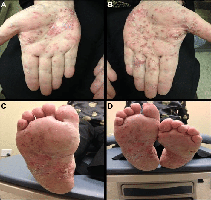 Palmoplantar-pustular-psoriasis