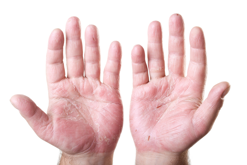 eczema on hands