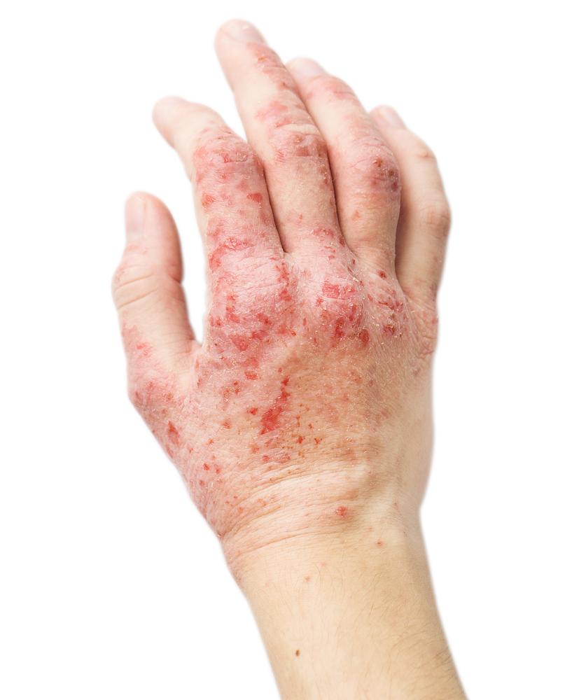 eczema on hands