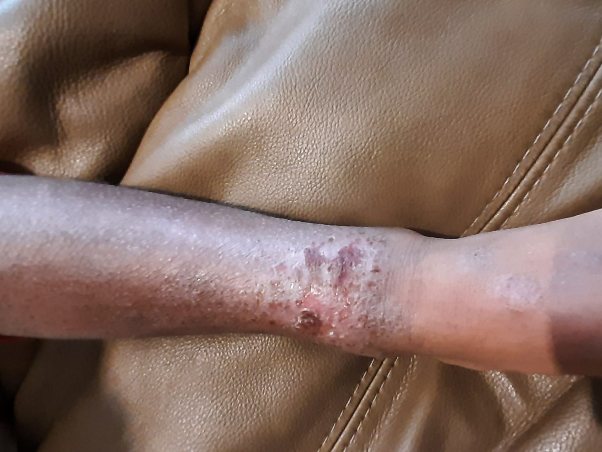 eczema on leg
