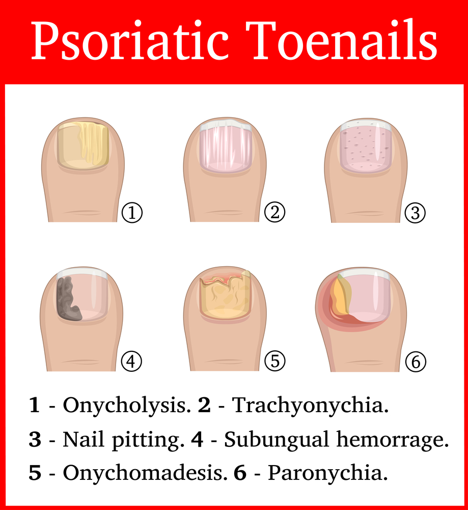 Psoriatic toe nails
