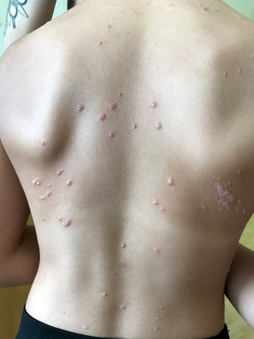 Guttate Psoriasis
