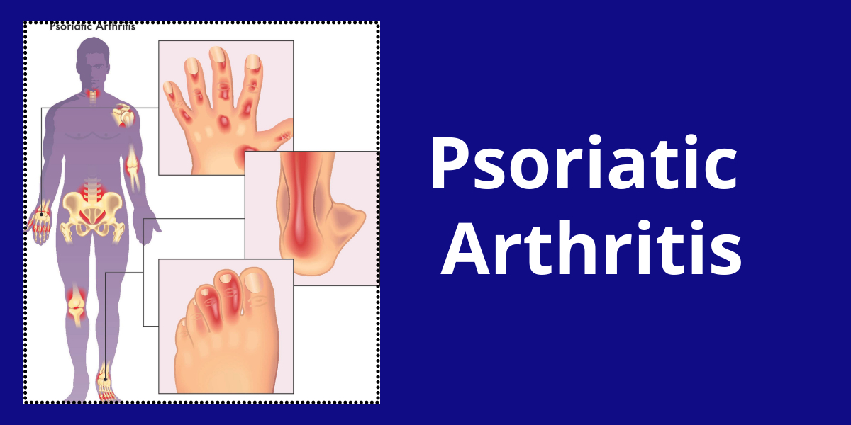 Psoriatic Arthritis Treatment in Bangalore
