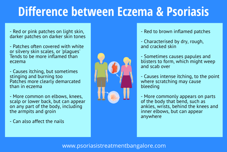 Differences between Eczema and Psoriasis