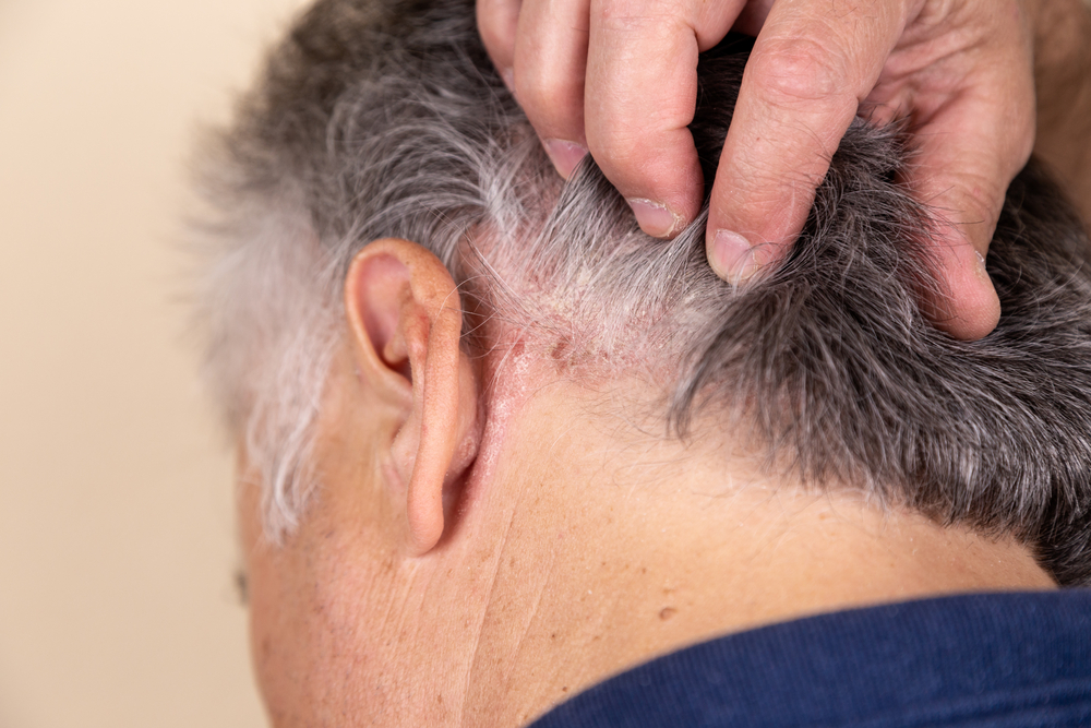 Scalp Psoriasis Images