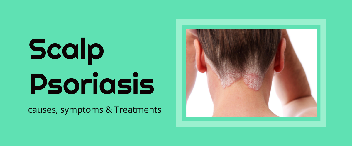 Scalp Psoriasis Treatment