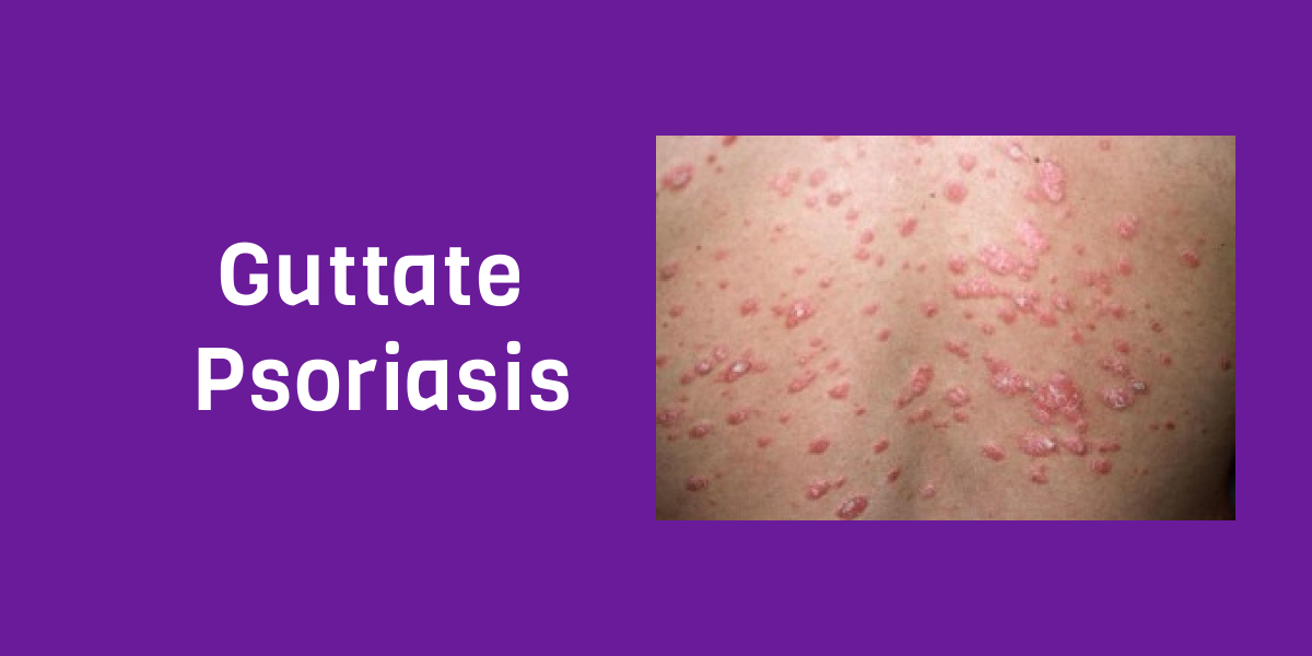 Guttate Psoriasis