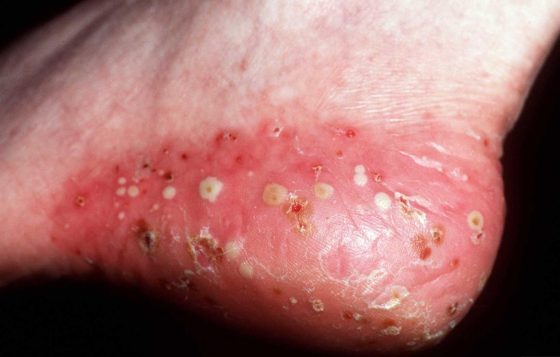 पस्टुलर-सोरायसिस-Pustular-Psoriasis