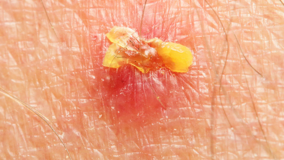 Psoriasis and Skin cancer