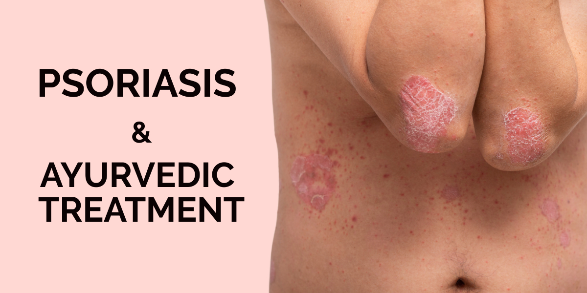 Ayurvedic Psoriasis Treatment