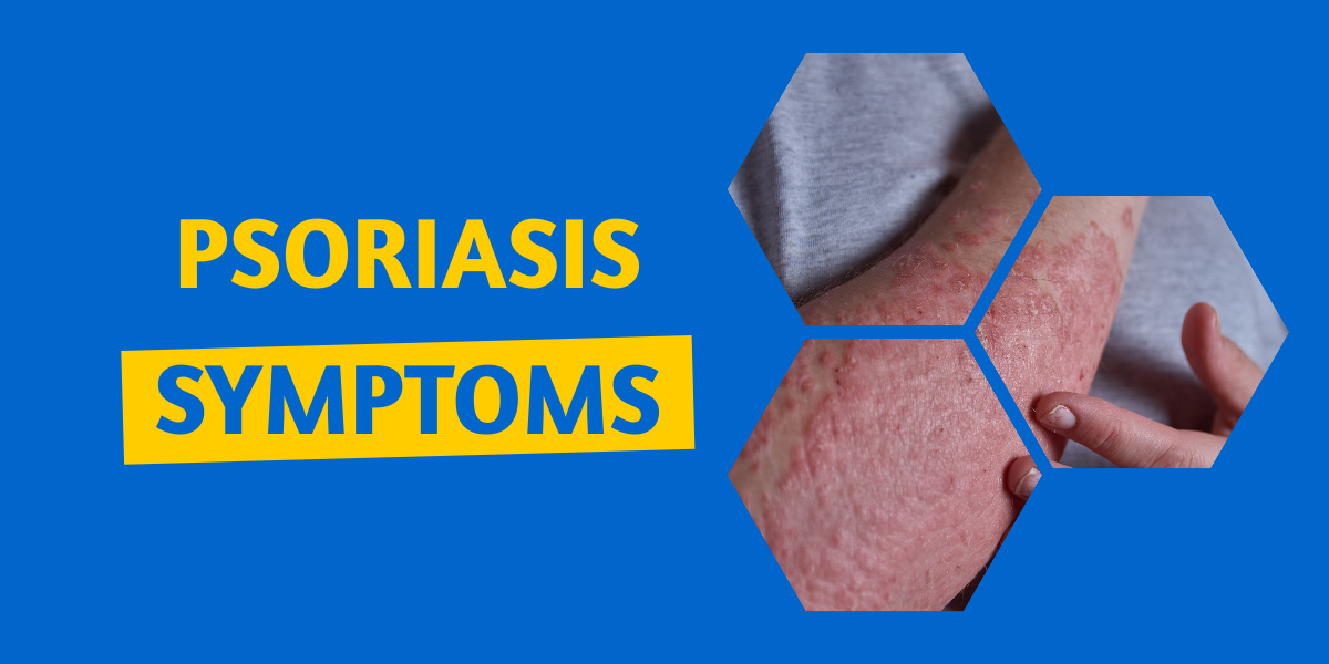 Psoriasis Symptoms
