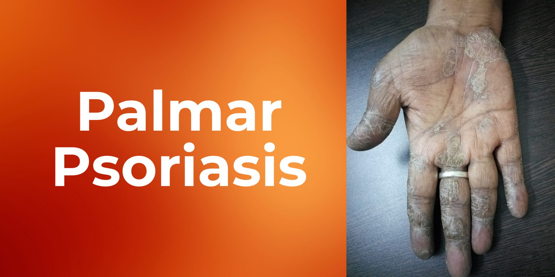 Palmar Psoriasis