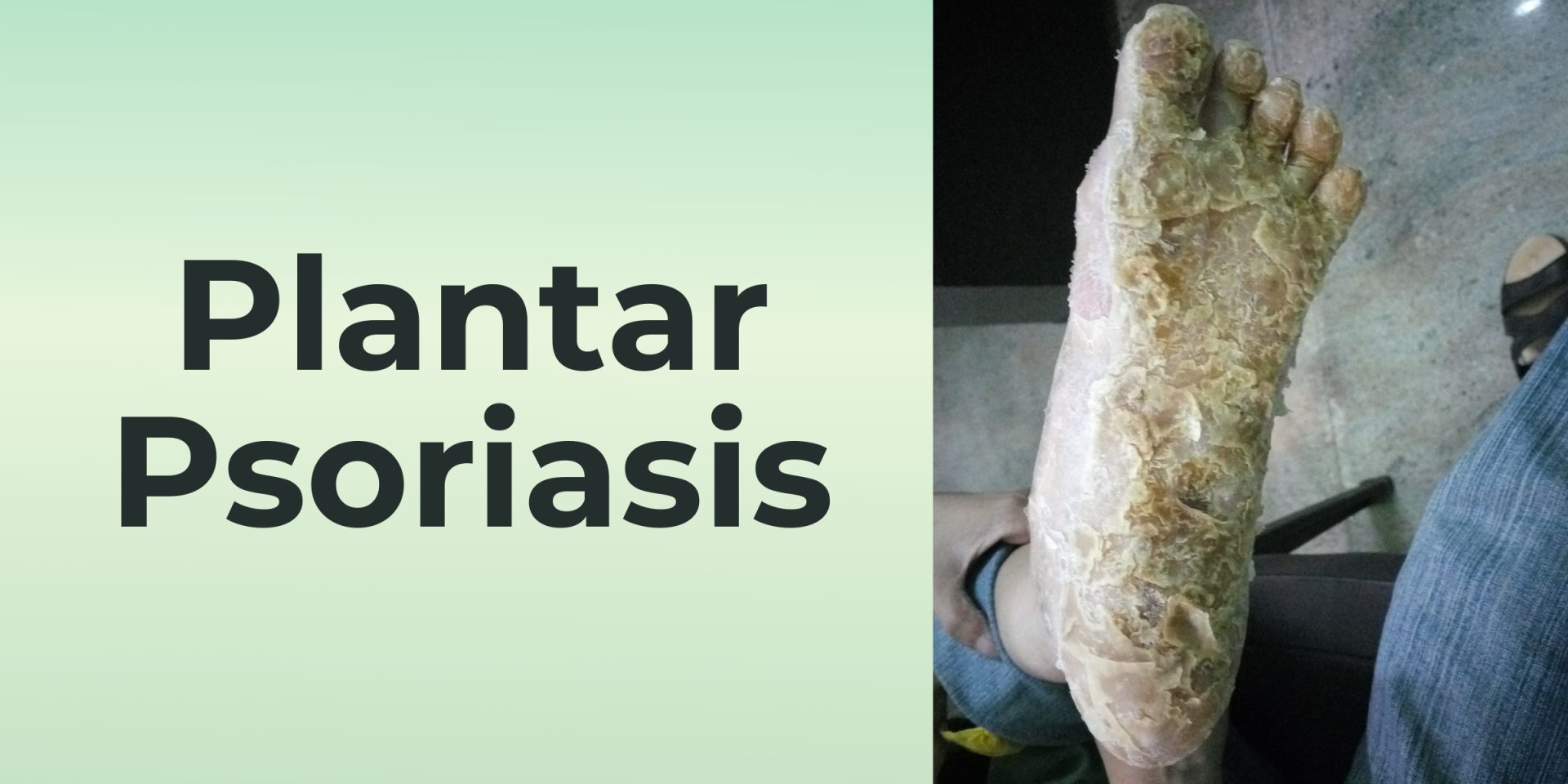 Plantar Psoriasis