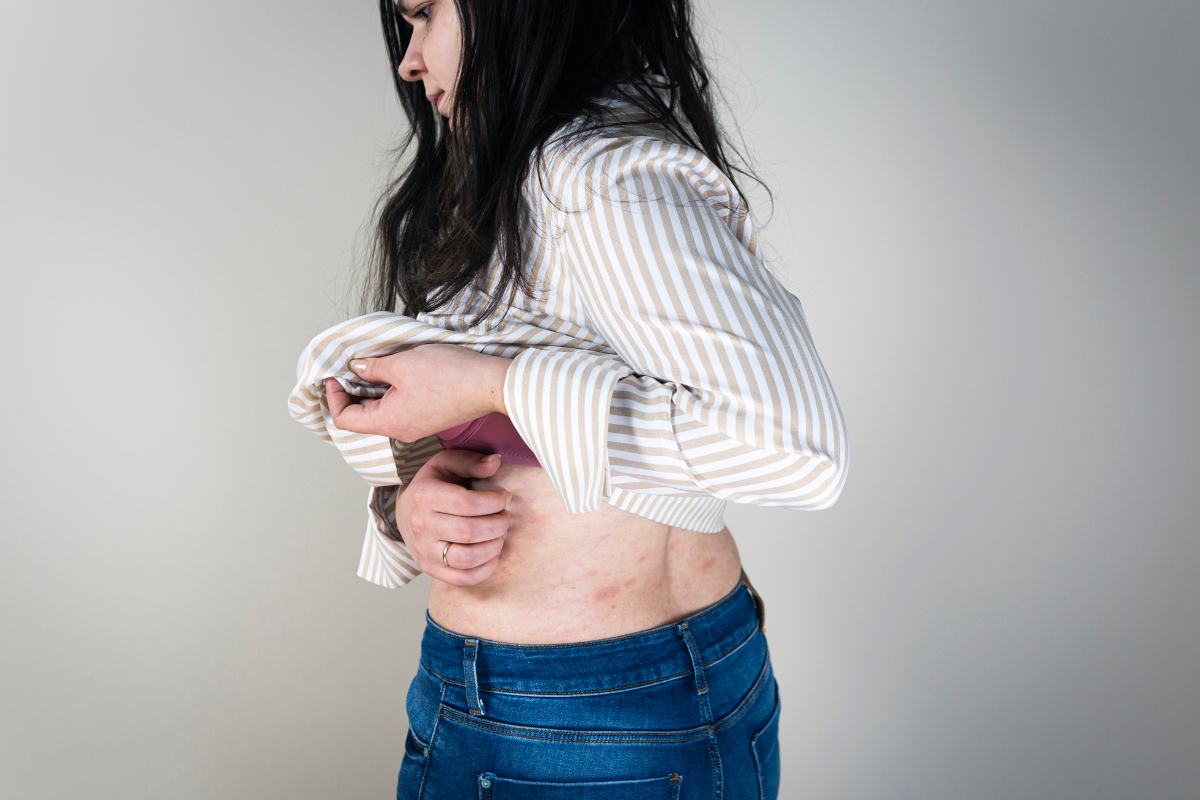 Inverse Psoriasis image