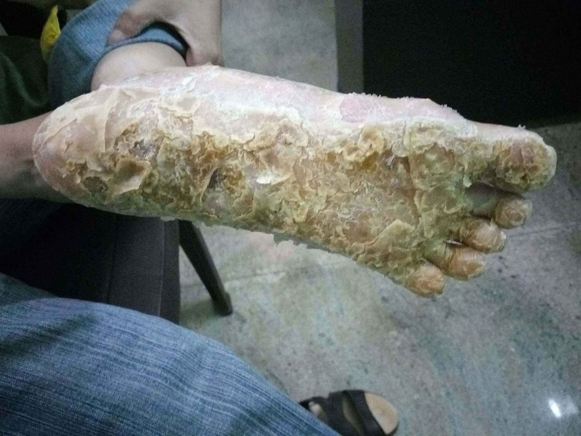 Plantar Psoriasis