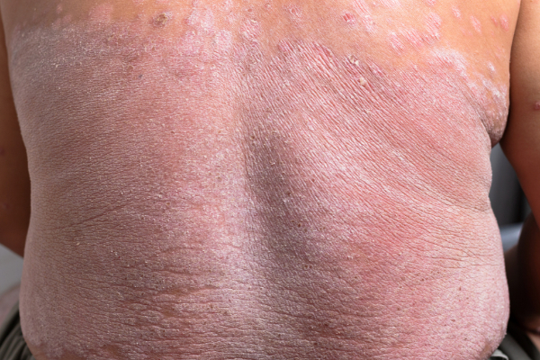 Plaque Psoriasis Image