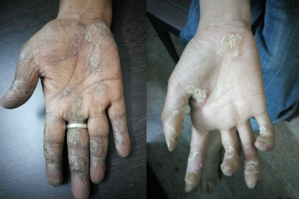 Symptoms-of-hand-psoriasis