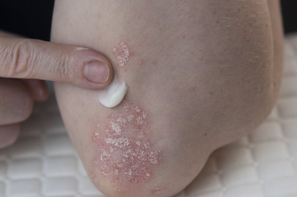 Ringworm and Psoriasis