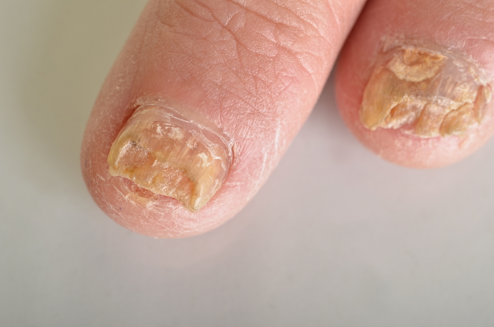 Nail Fungus