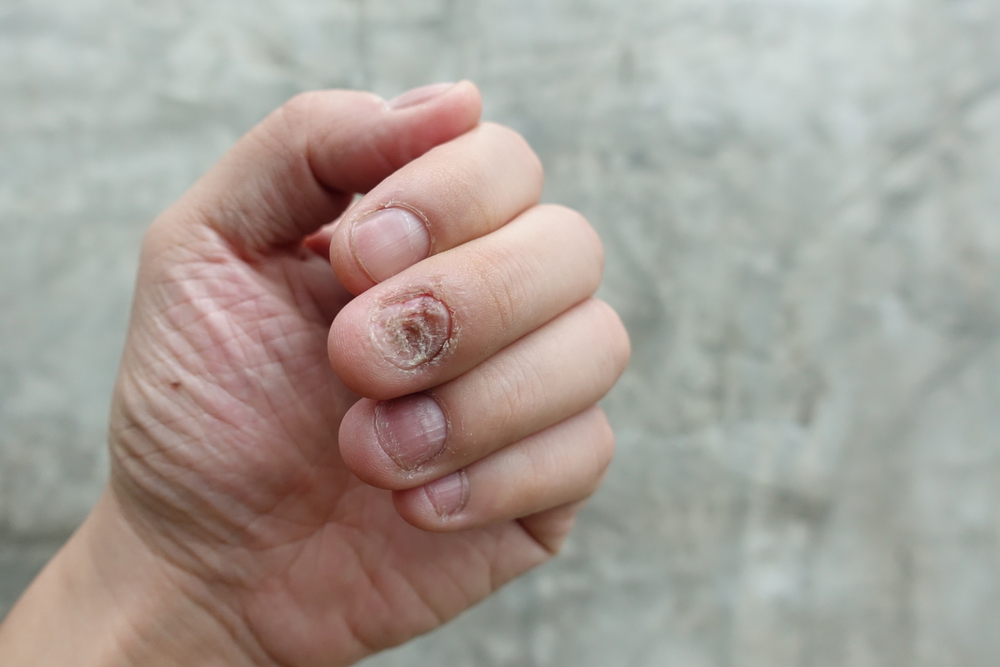 nail fungal infection