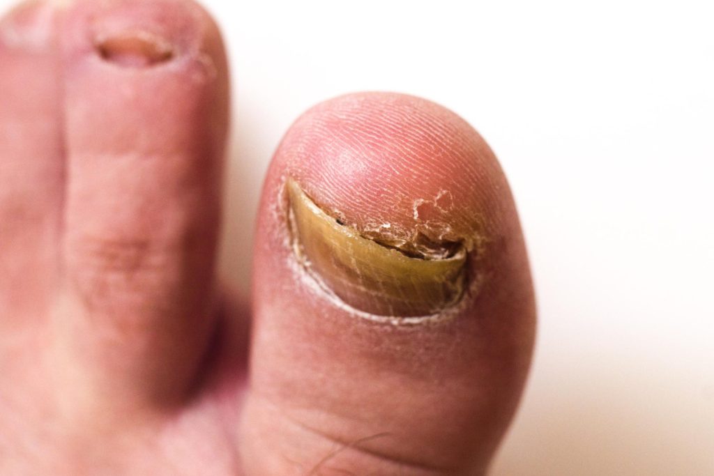 toe nail psoriasis image