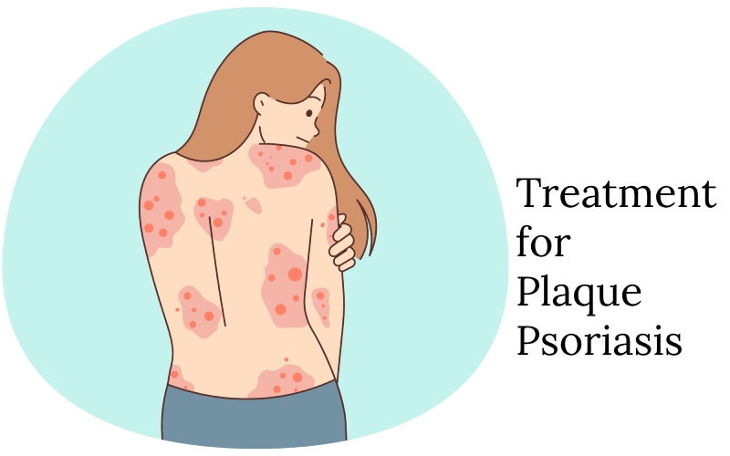 Treatment for Plaque Psoriasis