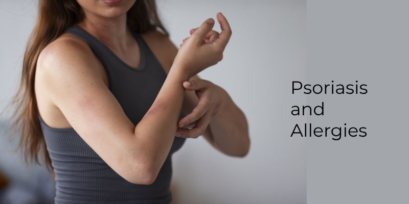 Psoriasis and Allergies