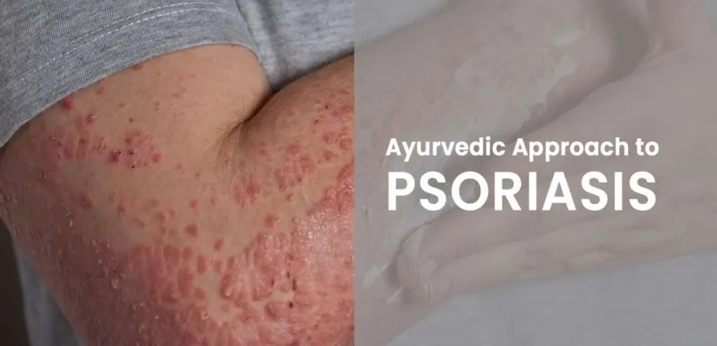 Best Ayurvedic Medicine for Psoriasis
