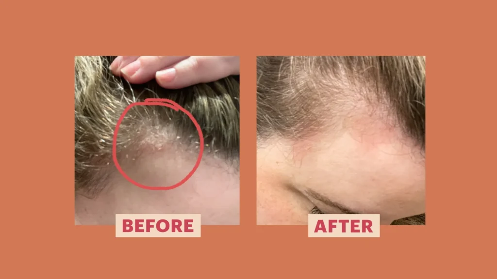 ayurvedic treatment for scalp psoriasis