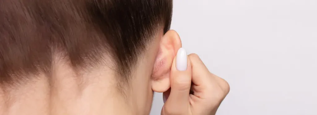 Psoriasis in Ears