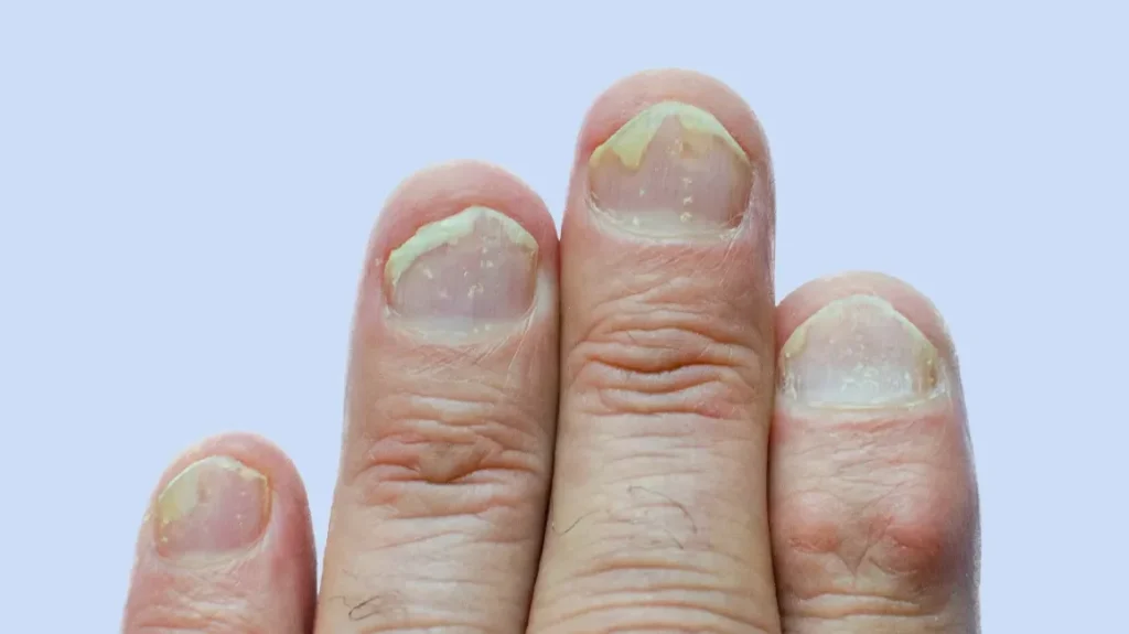 is nail psoriasis dangerous