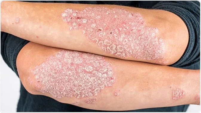 is psoriasis genetic