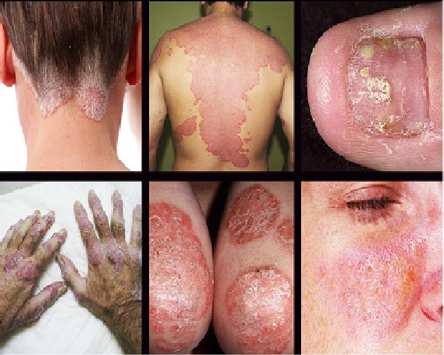 Psoriasis