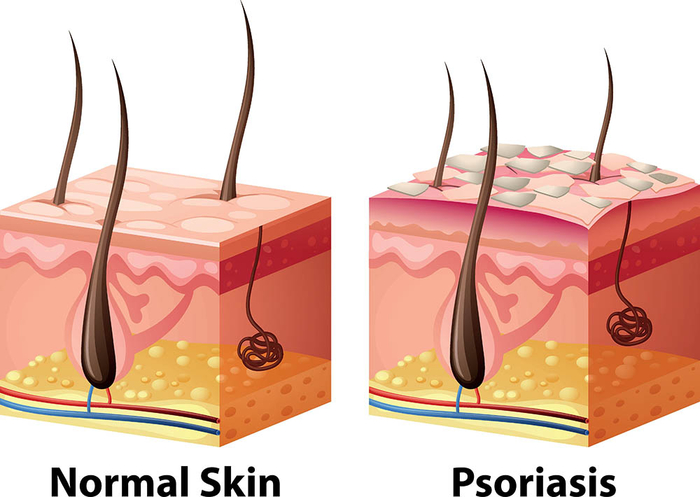 Human skin diagram with normal and psoriasis illustration How Psoriasis Spreads