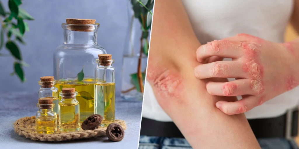 Neem Oil for Psoriasis