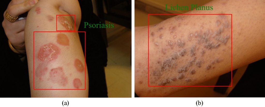 Lichen Planus vs Psoriasis