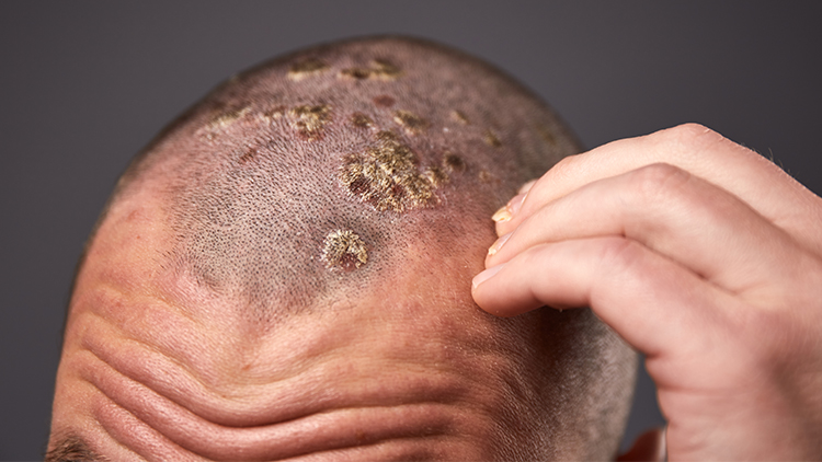 Scalp Psoriasis Treatment in Bangalore for Working Professionals
