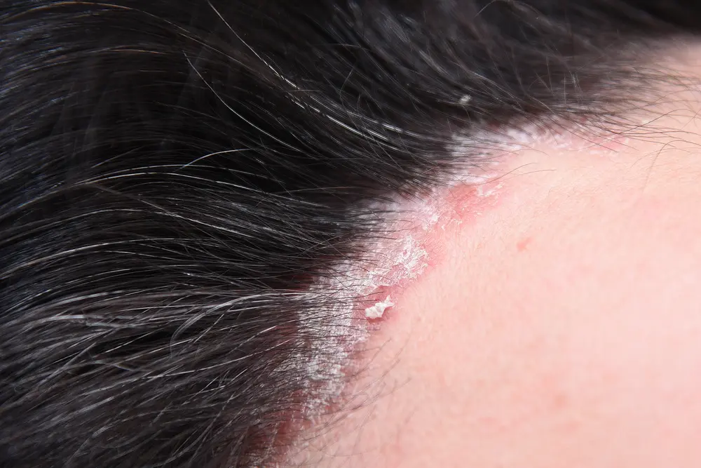 Scalp Psoriasis Treatment in Bangalore for women