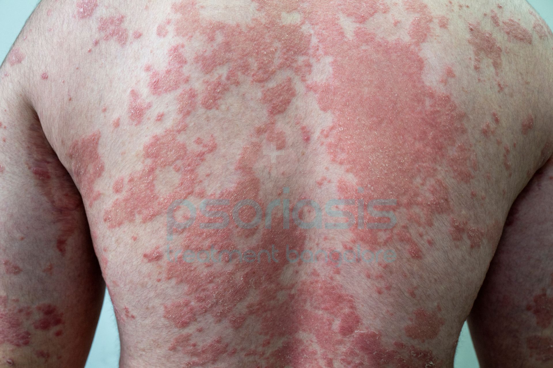 Psoriasis Treatment in Bangalore